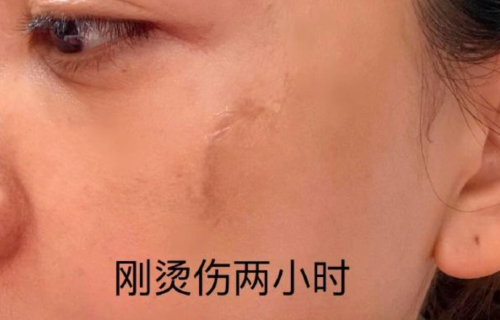 烫伤9天后疤痕基本消退！杨蓉晒“带疤的脸”直言很酷